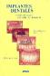 Implantes dentales