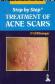 Treatment of Acne Scars