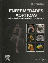 Enfermedades aorticas