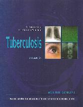 Tuberculosis