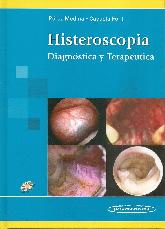 Histeroscopia