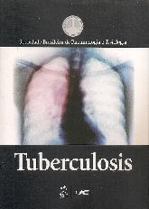 Tuberculosis