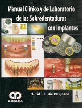 Manual Clnico y de Laboratorio de las Sobredentaduras con Implantes