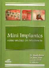 Mini Implantes