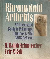 Rheumatoid Artritis