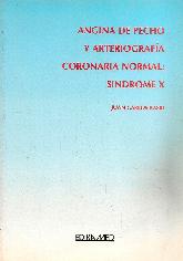 Angina de pecho y Arteriografia Coronaria Normal : Sindrome X