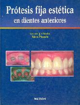 Protesis fija estetica en dientes anteriores