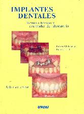 Implantes dentales