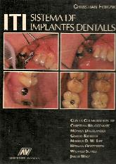 Sistemas de implantes dentales ITI