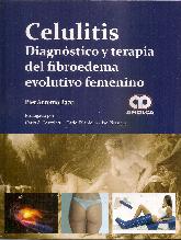 Celulitis