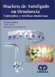 Brackets de Autoligado en Ortodoncia