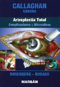 Callaghan Cadera Artroplastia Total