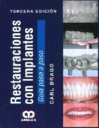 Restauraciones con Implantes