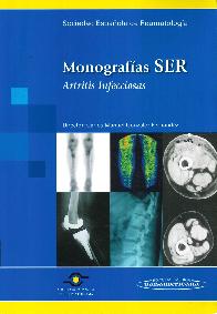 Monografas SER. Artritis Infecciosa
