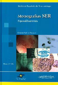 Monografas SER Espondiloartritis