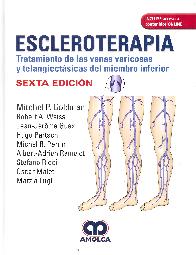 Escleroterapia