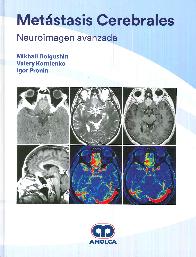 Metstasis Cerebrales