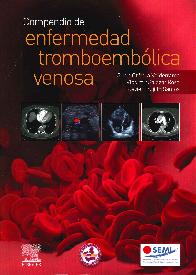 Compendio de enfermedad tromboemblica venosa