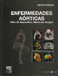 Enfermedades aorticas