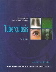 Tuberculosis