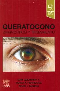 Queratocono. Diagnstico y tratamiento