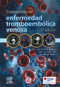 Compendio de enfermedad tromboemblica venosa