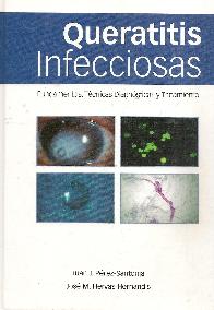 Queratitis Infecciosa