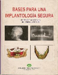 Bases para una implantologia segura