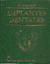 Implantes dentales