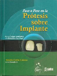 Paso a paso en la Prtesis sobre Implante