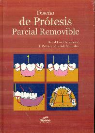 Diseo de Protesis Parcial Removible