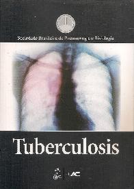 Tuberculosis