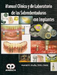 Manual Clnico y de Laboratorio de las Sobredentaduras con Implantes