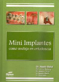 Mini Implantes