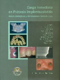 Carga inmediata en protesis implantoasistida