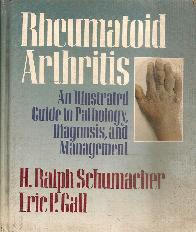 Rheumatoid Artritis