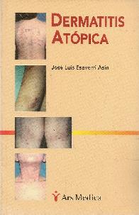 Dermatitis atopica