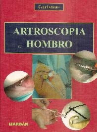 Artroscopa de hombro