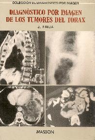 Diagnostico por imagen de los tumores del torax