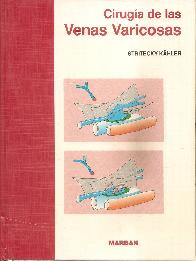 Cirugia de las venas varicosas