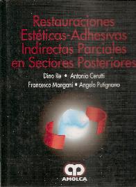 Restauraciones Esteticas-Adhesivas Indirectas Parciales en Sectores Posteriores