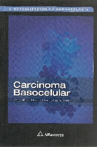 Carcinoma Basocelular