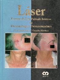 Lser y fuentes de luz pulsada intensa en dermatologa y dermocosmtica