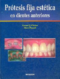 Protesis fija estetica en dientes anteriores