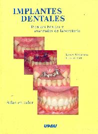 Implantes dentales 