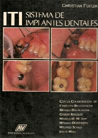 Sistemas de implantes dentales ITI