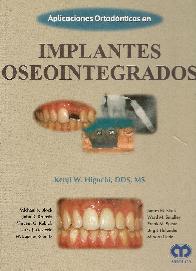 Aplicaciones Ortodnticas en Implantes Oseosintegrados