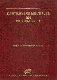 Cantilevers mltiples en prtesis fija