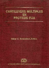 Cantilevers mltiples en prtesis fija