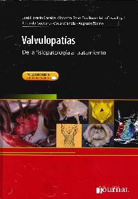 Valvulopatías 